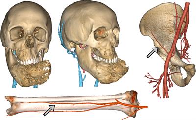 Double osseous flaps for simultaneous midfacial and mandible reconstruction: Automation in surgical complexity within an entirely computerized workflow